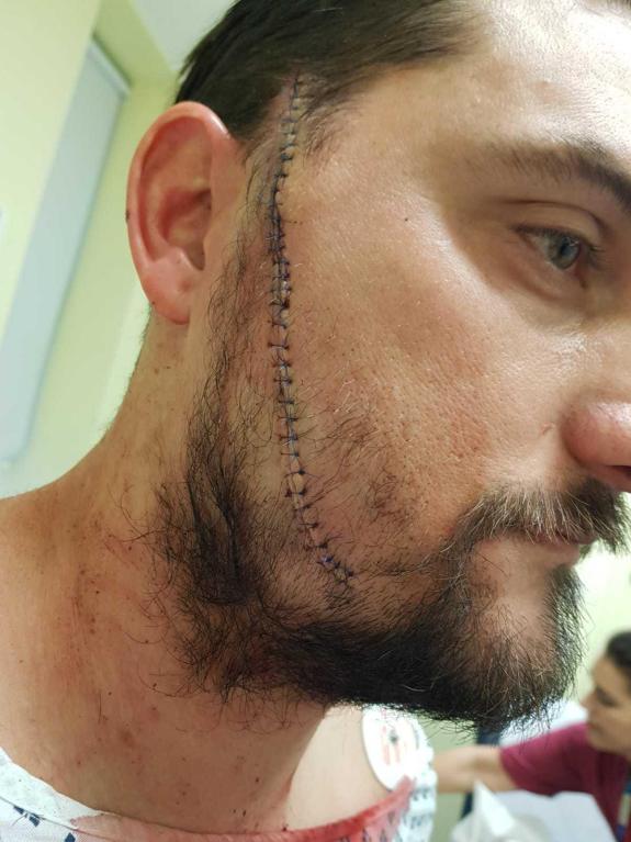 Clacton and Frinton Gazette: Paul Filtness after receiving hospital treatment Clacton and Frinton Gazette: Paul Filtness after receiving hospital treatment