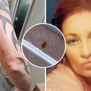 Pictures of the bites, the bed bug Lea says she found and Lea